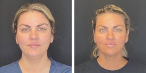 before and after facial liposuction female patient front view case 1774