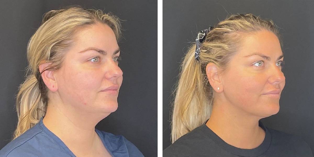 before and after facial liposuction female patient right angle view case 1774