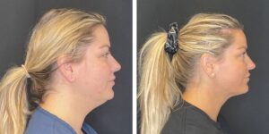 before and after facial liposuction female patient right side view case 1774