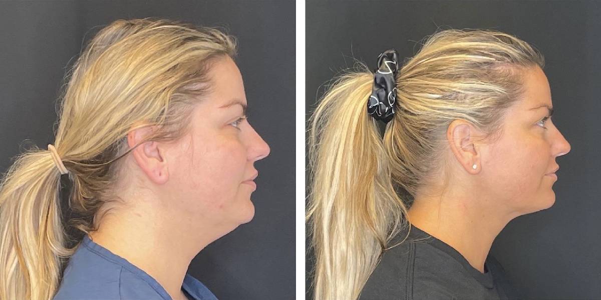 before and after facial liposuction female patient right side view case 1774