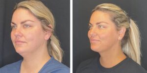 before and after facial liposuction female patient left angle view case 1774