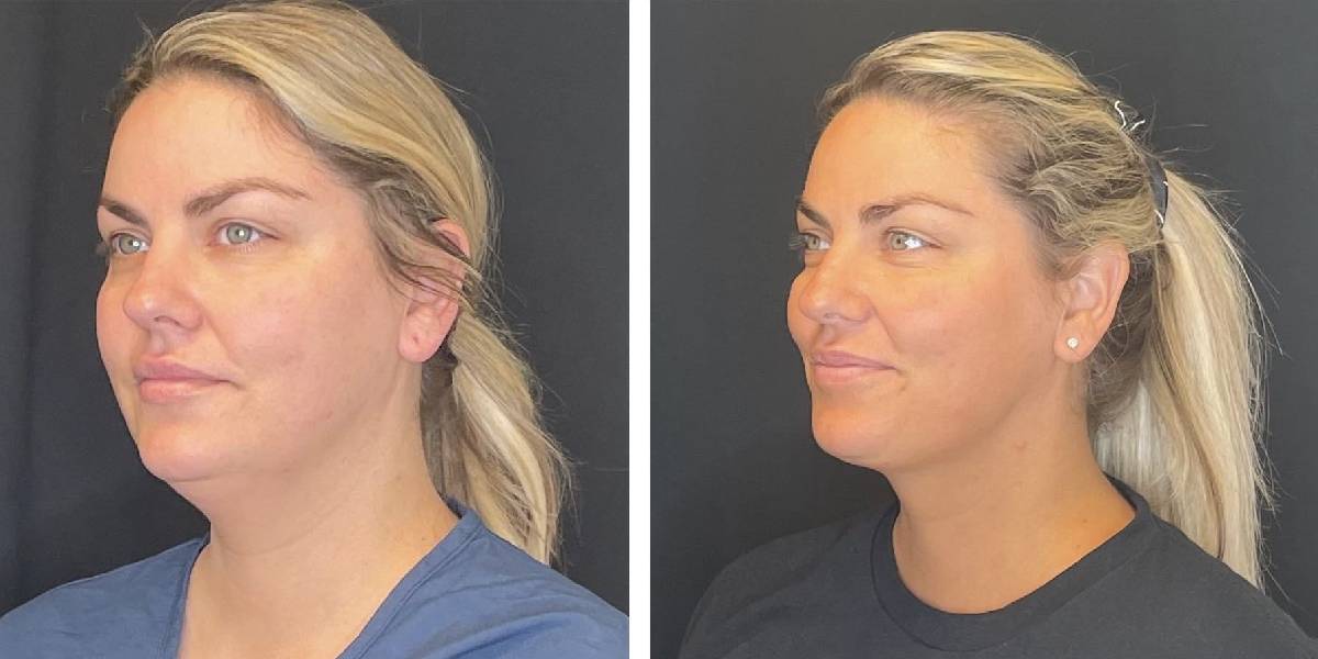 before and after facial liposuction female patient left angle view case 1774