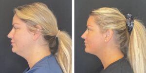 before and after facial liposuction female patient left side view case 1774