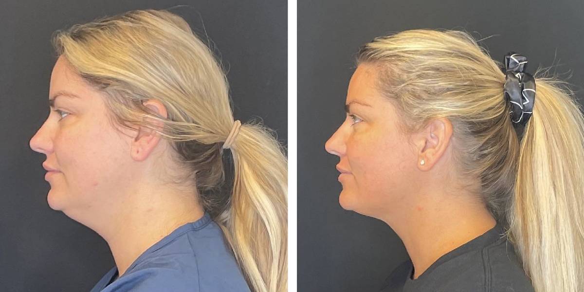 before and after facial liposuction female patient left side view case 1774