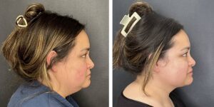 before and after facial liposuction female patient right side view case 1780