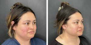 before and after facial liposuction female patient right angle view case 1780