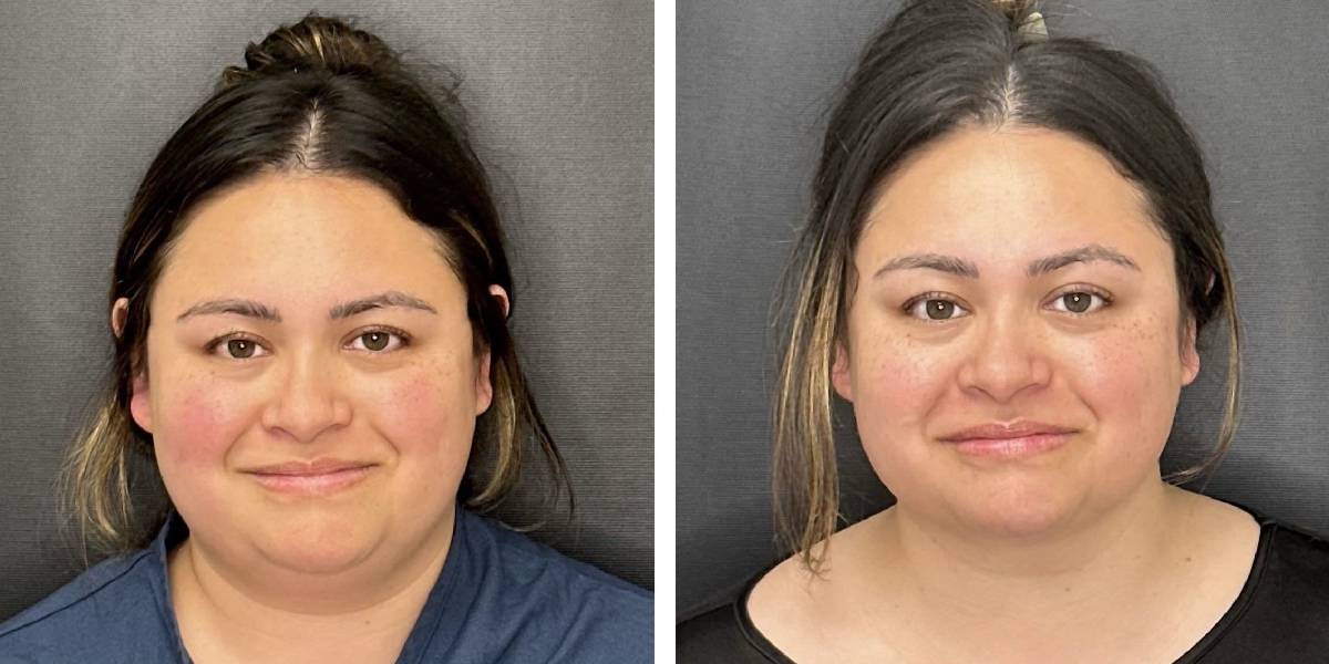 before and after facial liposuction female patient front view case 1780