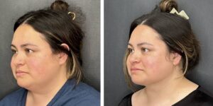 before and after facial liposuction female patient left angle view case 1780
