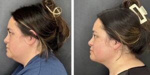 before and after liposuction face female patient left side view case 1780