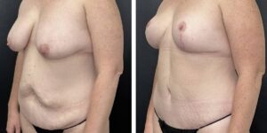before and after mommy makeover female patient left angled view case 1813