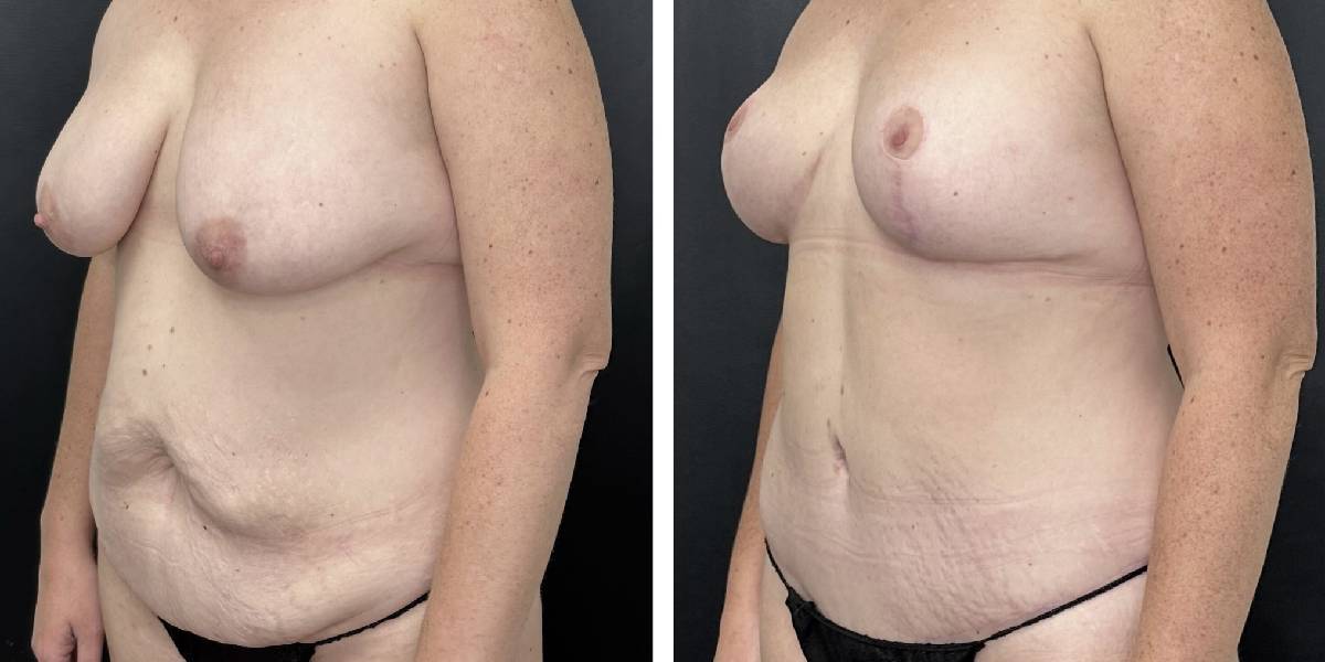 before and after mommy makeover female patient left angled view case 1813