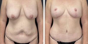 before and after mommy makeover female patient front view case 1813