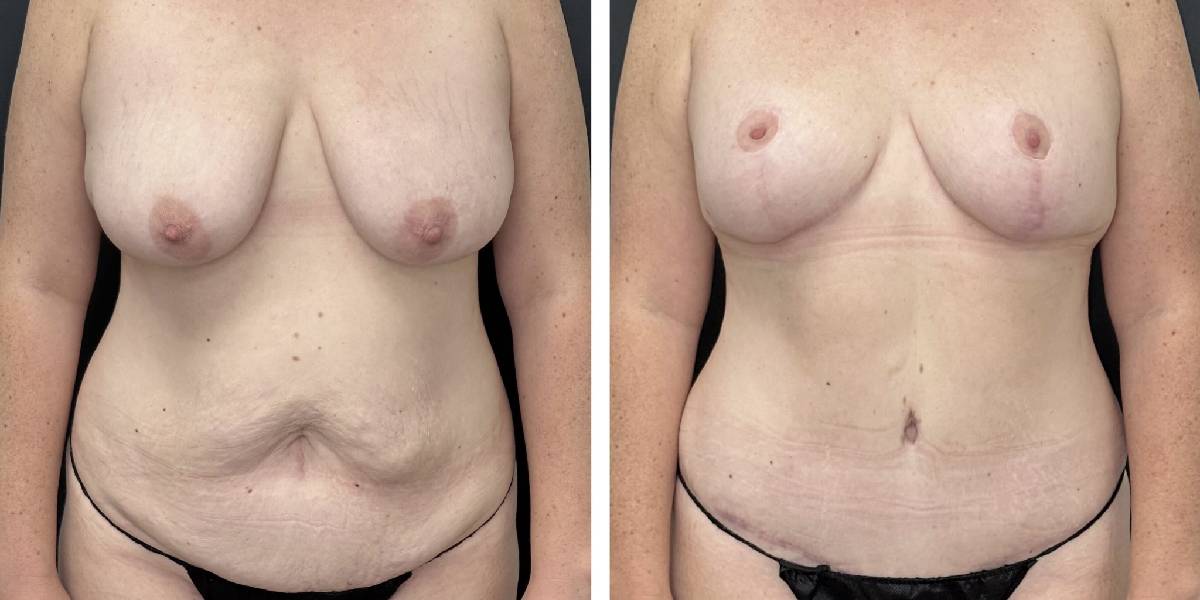 before and after mommy makeover female patient front view case 1813