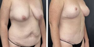 before and after mommy makeover female patient right angled view case 1813