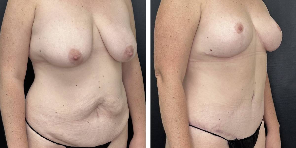 before and after mommy makeover female patient right angled view case 1813
