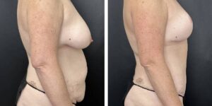 before and after mommy makeover female patient right side view case 1813