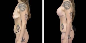 before and after mommy makeover female patient left side view case 1819