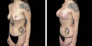 before and after mommy makeover female patient left angled view case 1819
