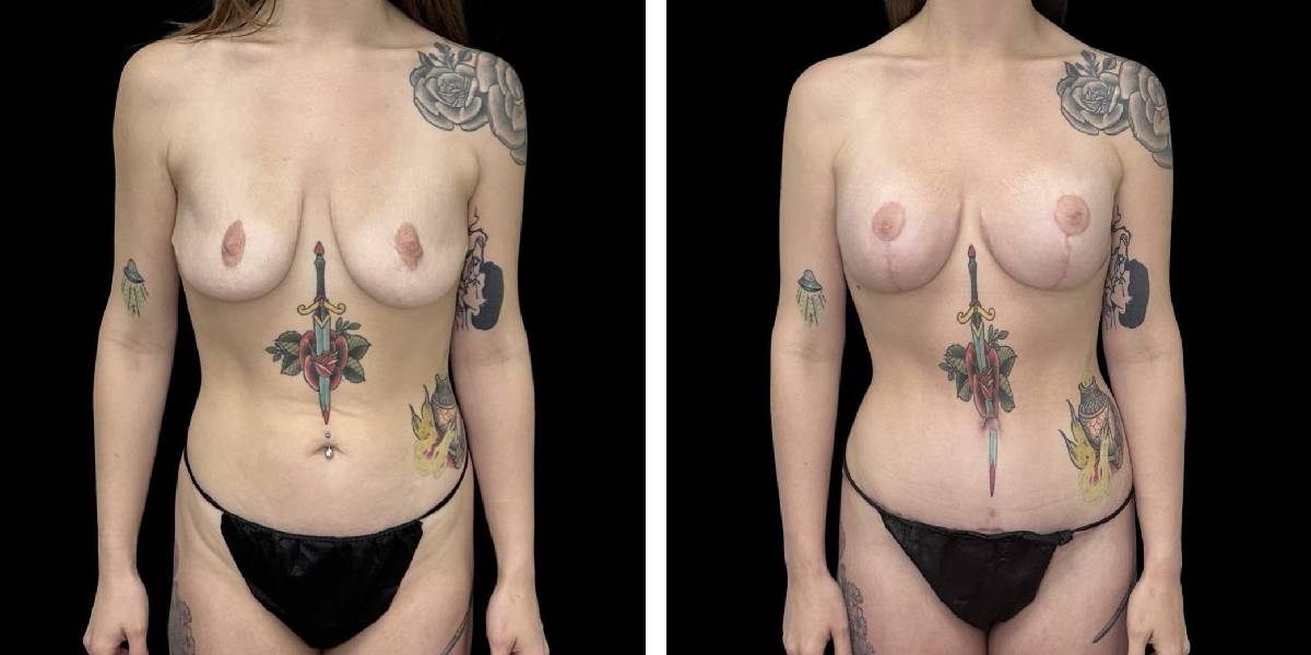 before and after mommy makeover female patient front view case 1819