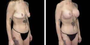 before and after mommy makeover female patient right angled view case 1819