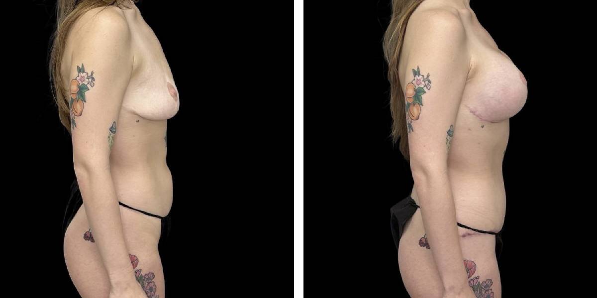 before and after mommy makeover female patient right side view case 1819