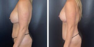 before and after mommy makeover female patient left side case 1825