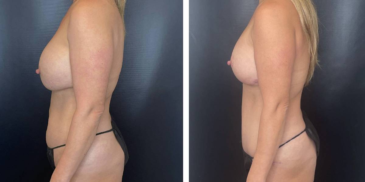 before and after mommy makeover female patient left side case 1825