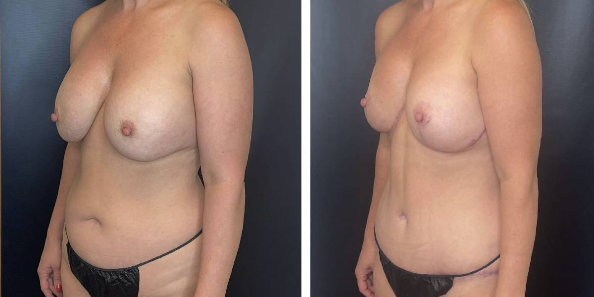 before and after mommy makeover female patient left angled view case 1825