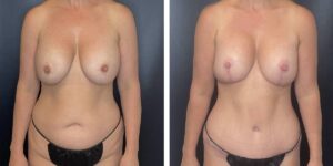 before and after mommy makeover female patient front view case 1825