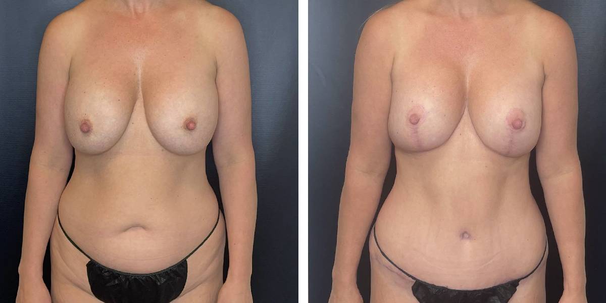 before and after mommy makeover female patient front view case 1825