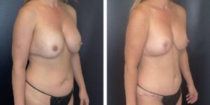 before and after mommy makeover female patient right angled view case 1825