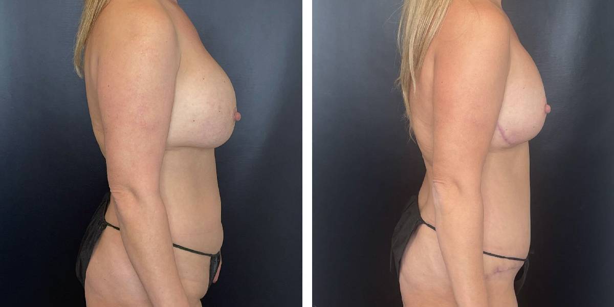 before and after mommy makeover female patient right side view case 1825