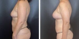 before and after mommy makeover female patient left side view case 1831
