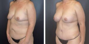 before and after mommy makeover female patient left angled view case 1831