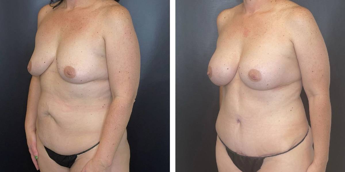before and after mommy makeover female patient left angled view case 1831
