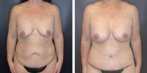 before and after mommy makeover female patient front view case 1831