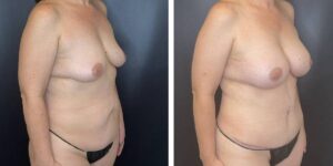 before and after mommy makeover female patient right angled view case 1831