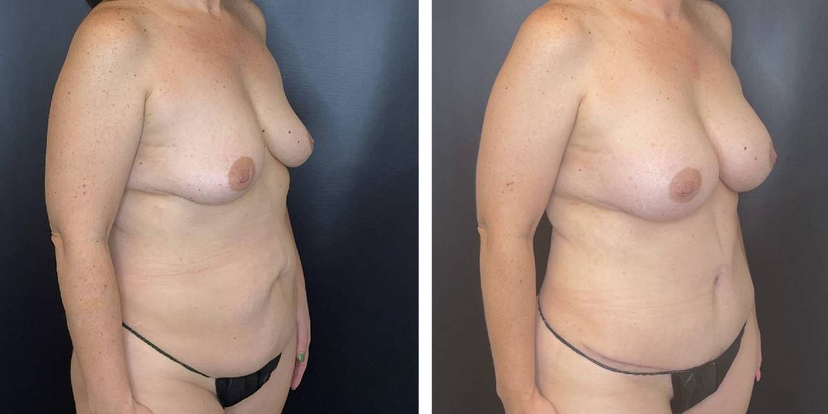 before and after mommy makeover female patient right angled view case 1831