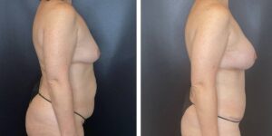 before and after mommy makeover female patient right side view case 1831