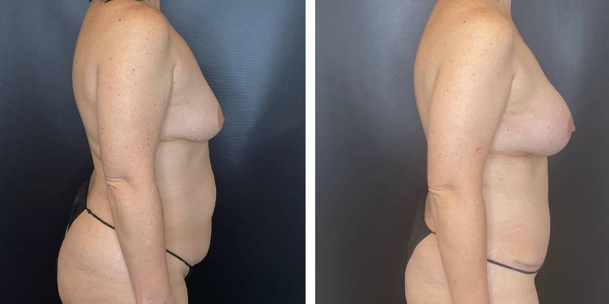 before and after mommy makeover female patient right side view case 1831