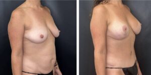 before and after mommy makeover female patient right angled view case 1837