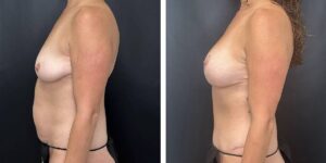 before and after mommy makeover female patient left side view case 1837