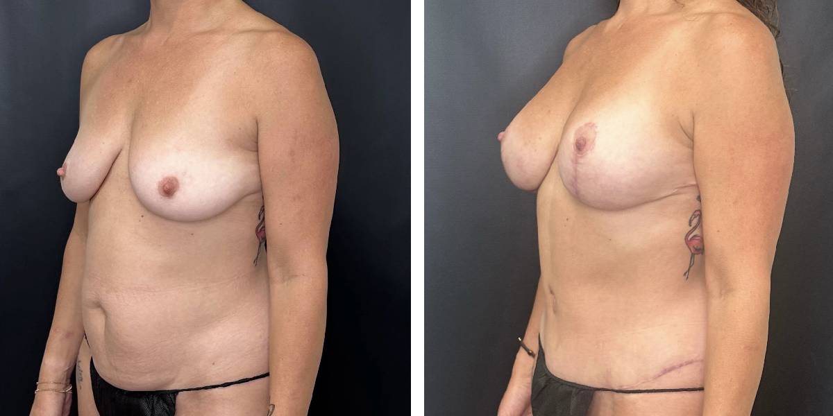before and after mommy makeover female patient left angled view case 1837