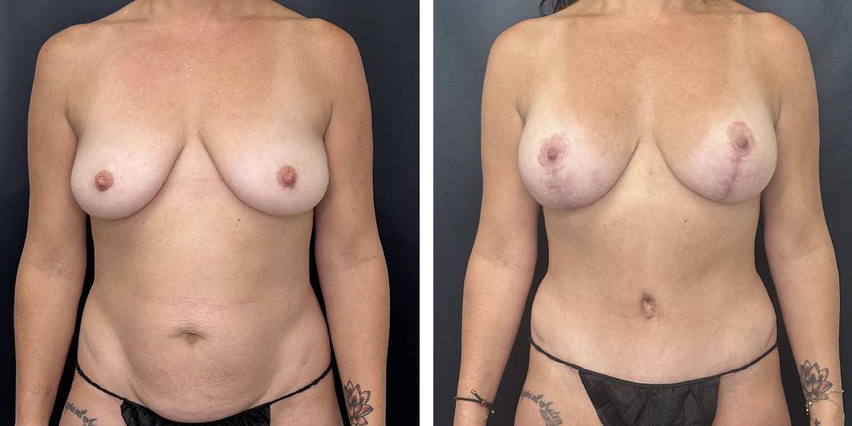before and after mommy makeover female patient front view case 1837