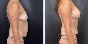 before and after mommy makeover female patient right side view case 1837