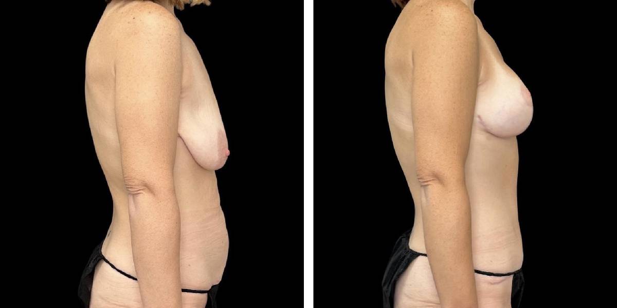 before and after mommy makeover female patient right side view case 1843