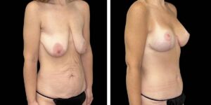 before and after mommy makeover female patient right angled view case 1843