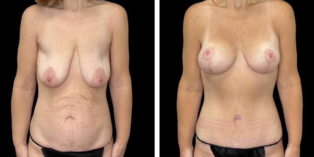 before and after mommy makeover female patient front view case 1843