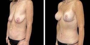 before and after mommy makeover female patient left angled view case 1843