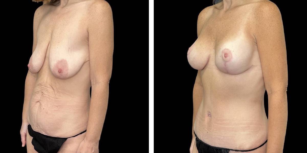 before and after mommy makeover female patient left angled view case 1843